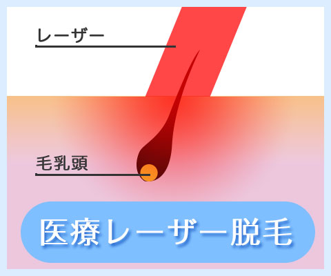 医療レーザー脱毛照射イメージ