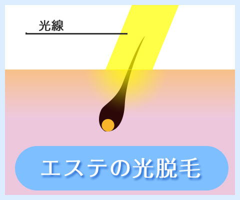 エステの光脱毛照射イメージ